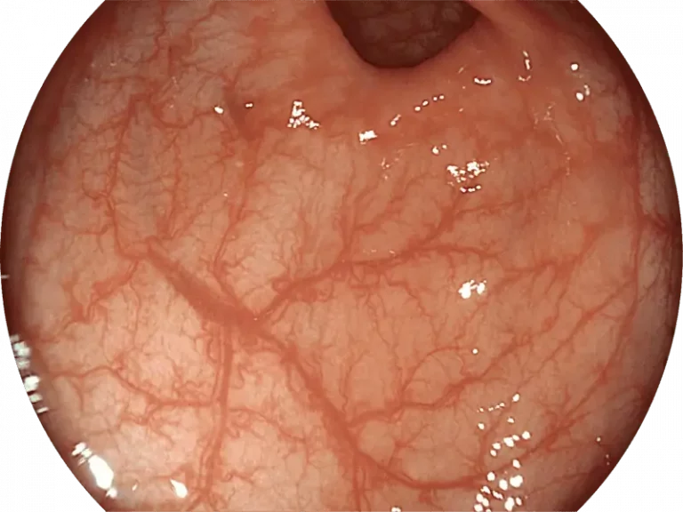 sonoscape-ice-disabled